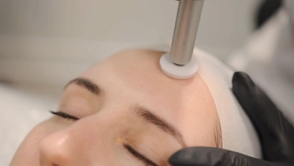 Microneedling treatmet on the forehead