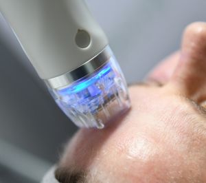 Close up of microneedling treatment