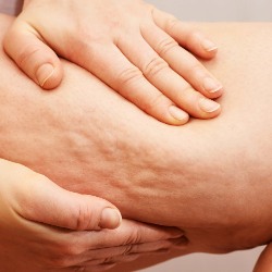 Cellulite Treatment