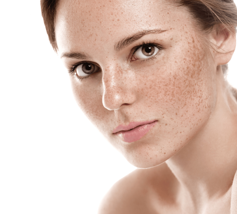 Woman's face showing sun damage repair